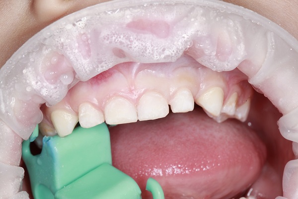 Темнеют зубы – причины, последствия, как исправить