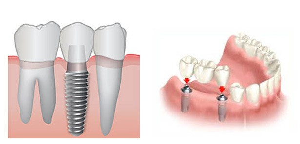 Как выглядит имплант зуба и от чего зависит его цена?