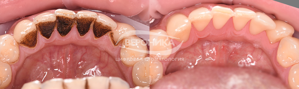 Чистка налета на зубах и удаление камня | Примеры работ - фото до и после