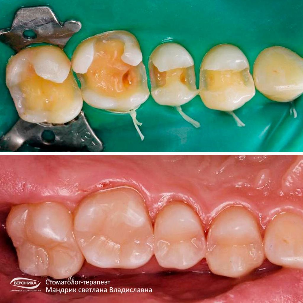 Начальный и поверхностный кариес: симптомы и методы лечения зубов